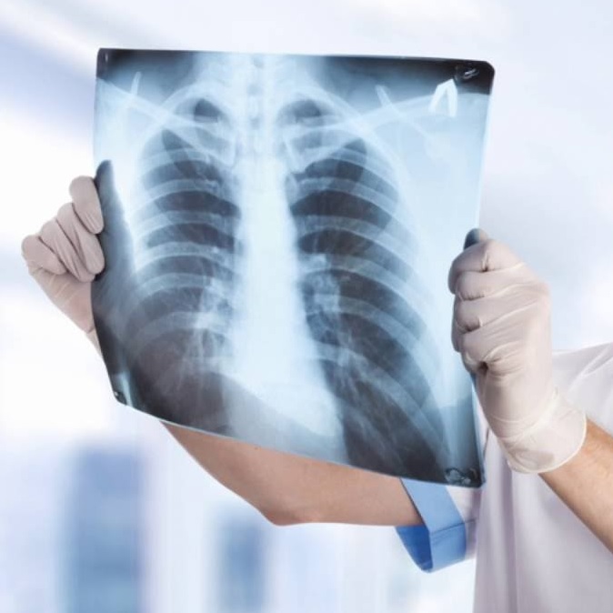 Növeli-e a rák kockázatát a röntgen és az orvosi képalkotás?