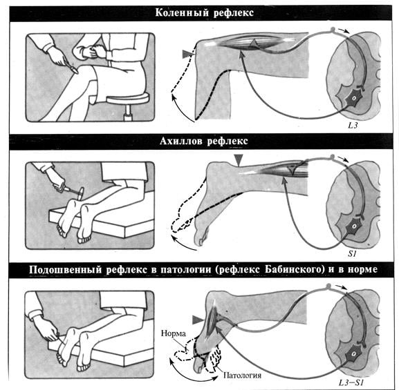 Схема рефлекторной дуги ахиллова рефлекса